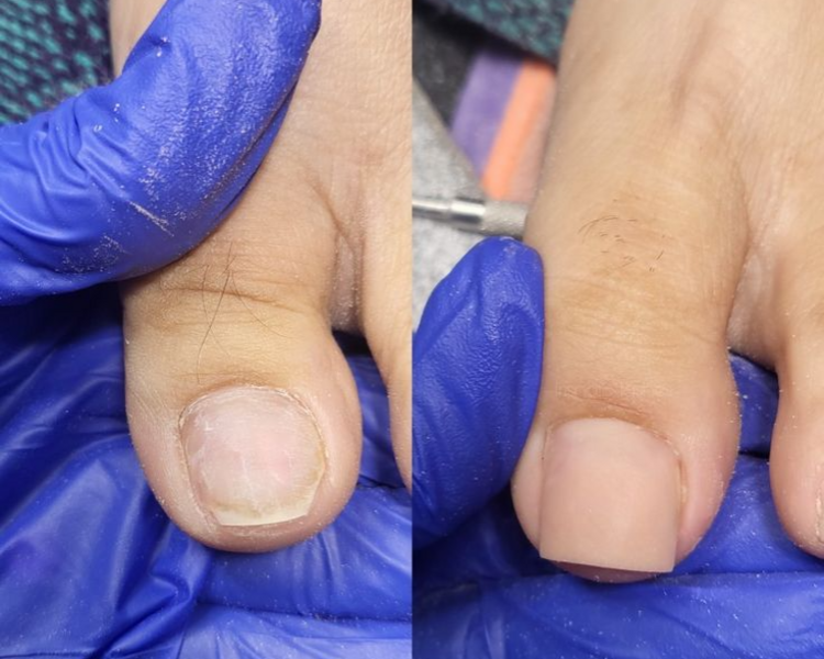 Reconstrucción de Uña del Pie (por uña)