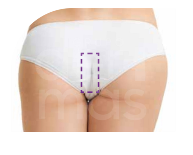 Depilación Zona Perineal