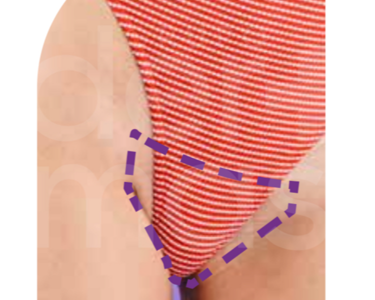 Depilación Bikini Completo 