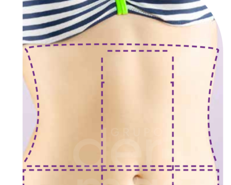 Depilación Abdomen Superior