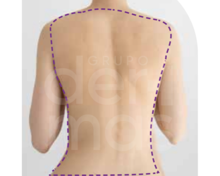 Depilación Espalda Completa