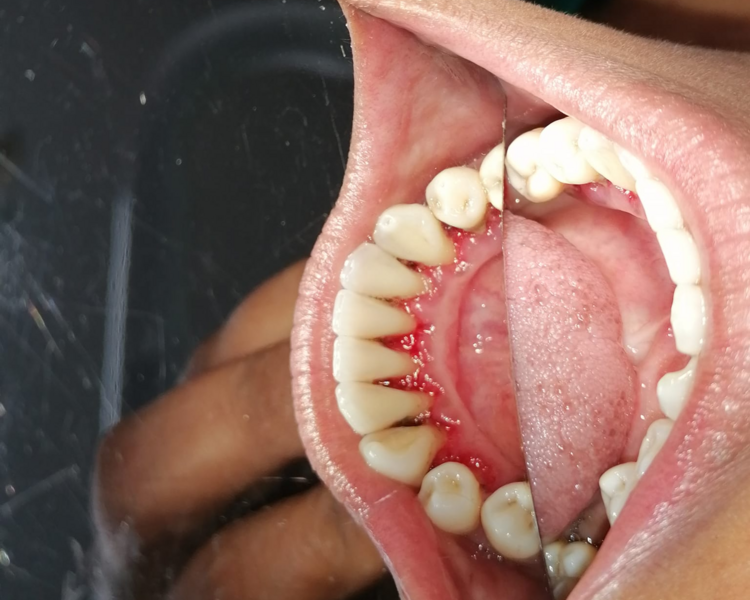 LIMPIEZA DENTAL ULTRASONICA