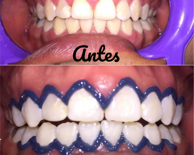 BLANQUEAMIENTO DENTAL