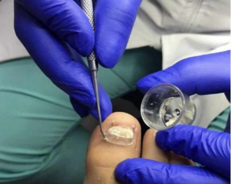 Quiropedia correctiva onicomicosis