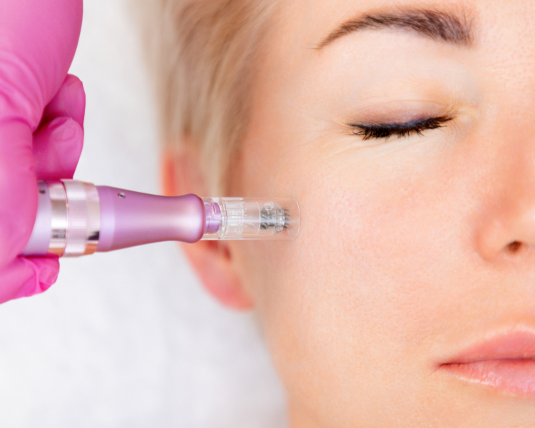 Microneedling