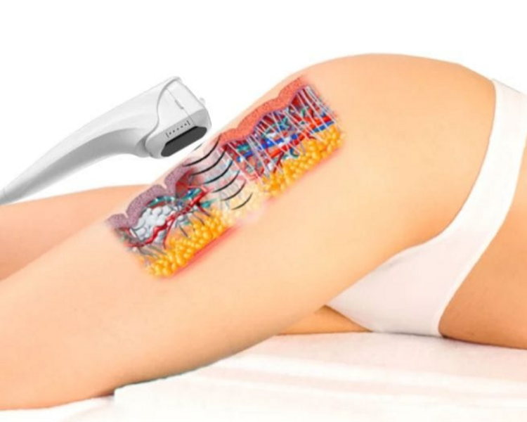 Hifu 12D (Aductores)