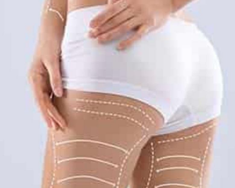 Hifu 12D ( Glúteos)