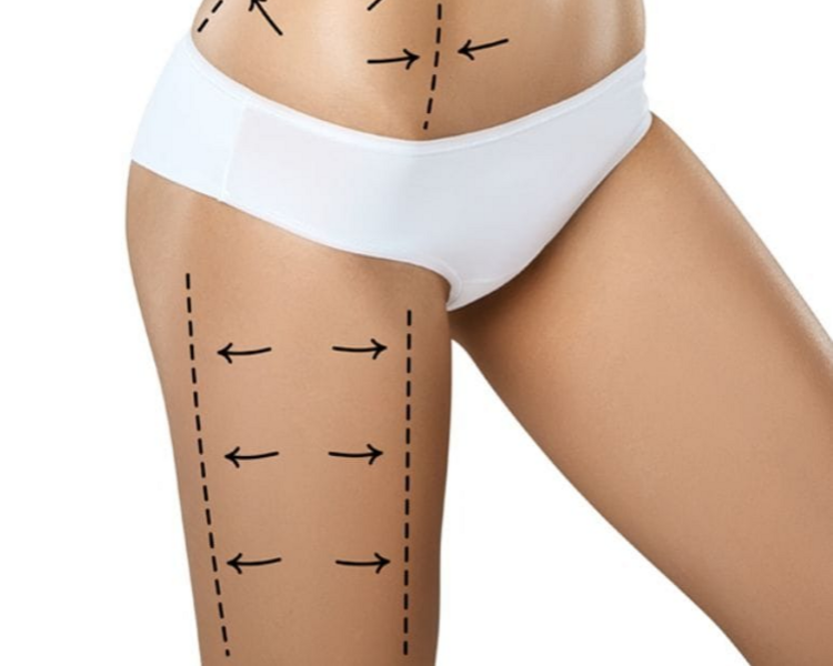 Hifu 12D (Muslo Posterior & Anterior)