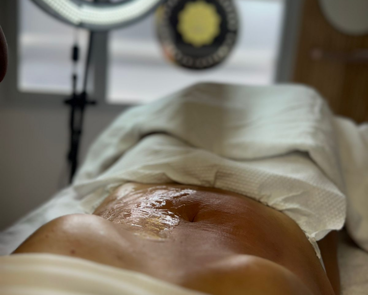 Vela Sculping (Abdomen)