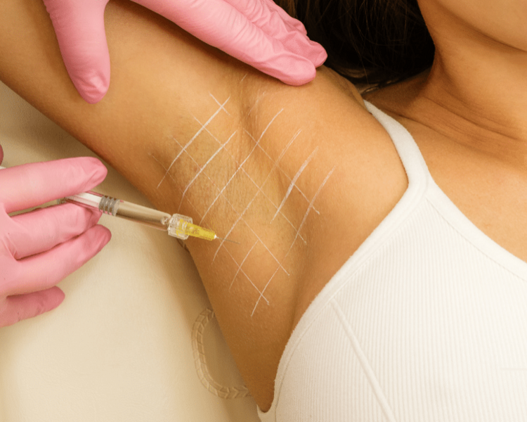 Mesobotox 50UI (hiperidrosis)