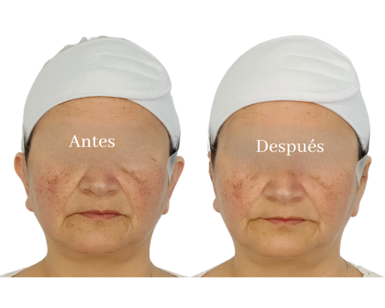 Armonización de Orejas con Hilos