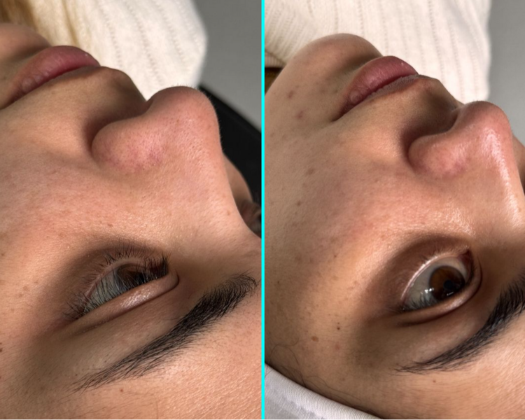 Limpieza Facial Profunda