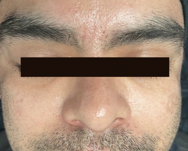 ✨Dermapen antiacné