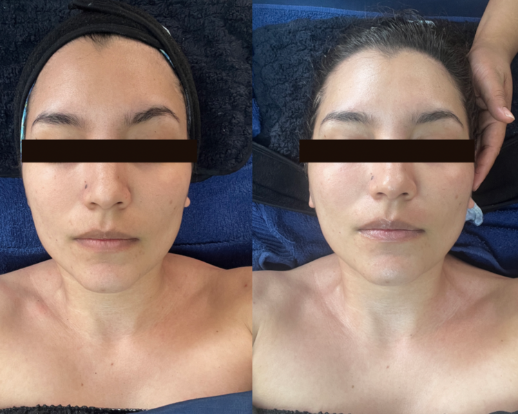 🌟Inducción de Colágeno Despigmentante 