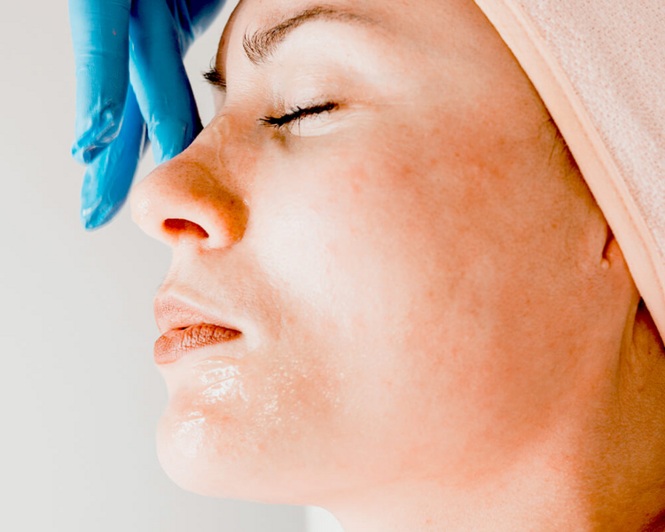 Tratamiento de Acne Pre y Post 3 Sesiones Técnica: Hydrapen H5, hollywood peel y protocolo químico