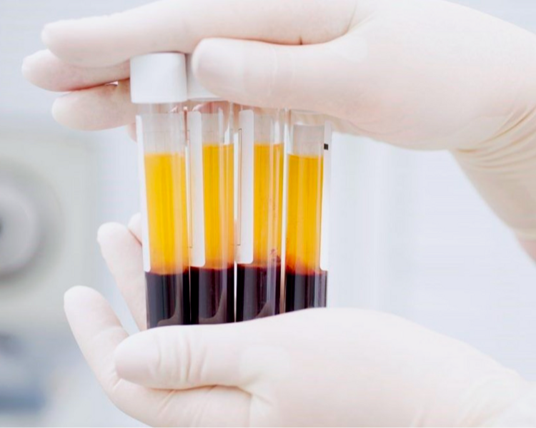 Plasma rico en plaquetas facial