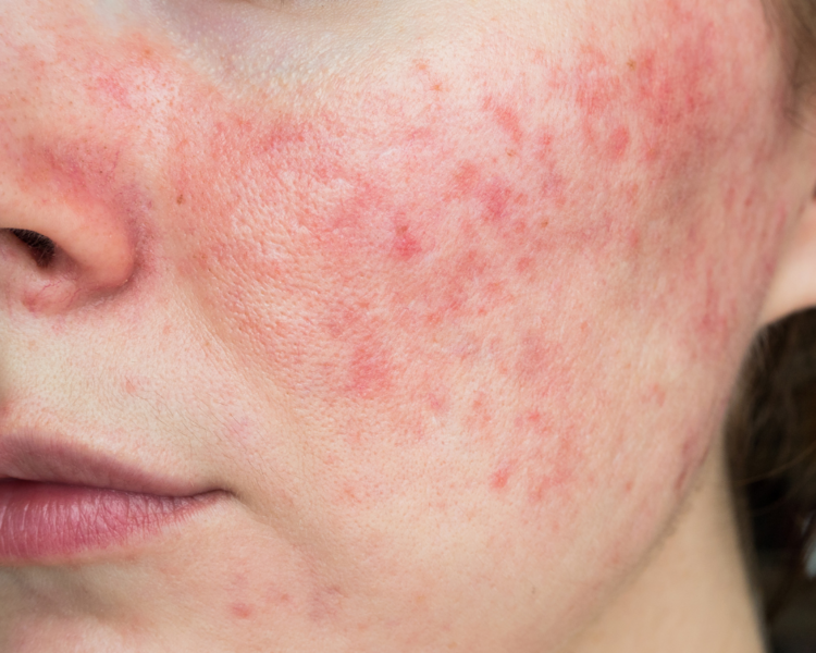 Tratamiento de rosacea