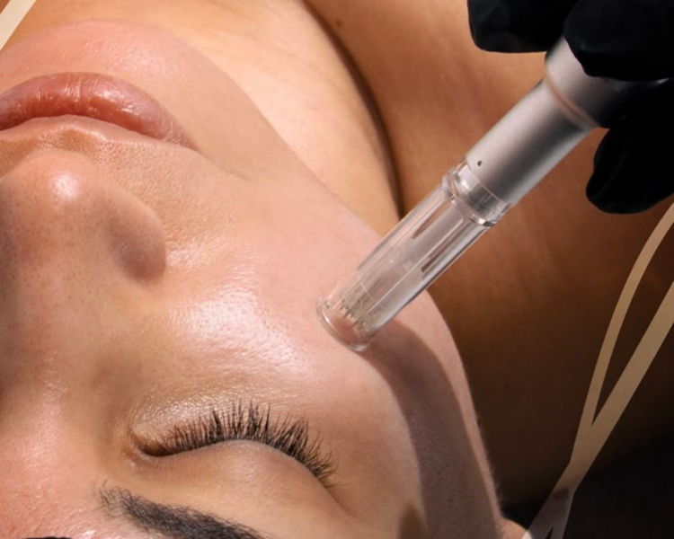 Dermapen + Booster de Ácido Hialurónico + Vitamina C ✨