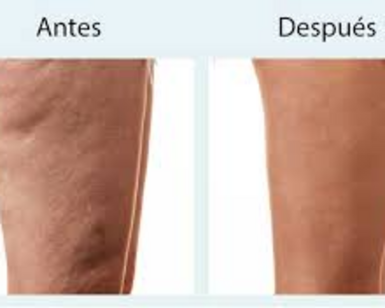 Celulitis Tratamiento 12 sesiones
