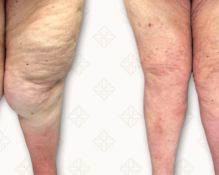 Lipedema Tratamiento 8 sesiones
