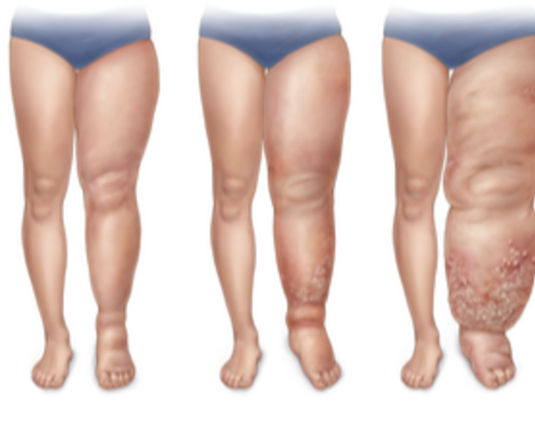 Linfedema Tratamiento 10 Sesiones