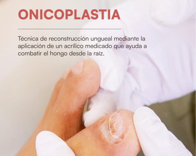 Onicoplastia medicada 5 uñas