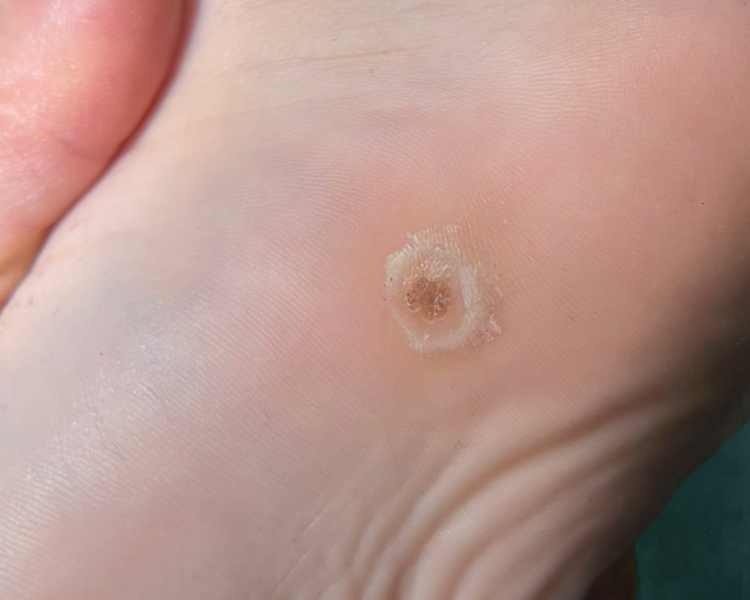 Verrugas Plantares