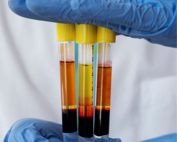 Plasma rico en plaquetas 