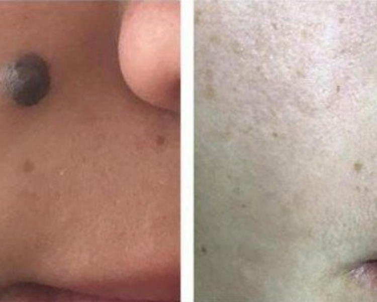 Cauterizacion lunares,verrugas,acrocordones