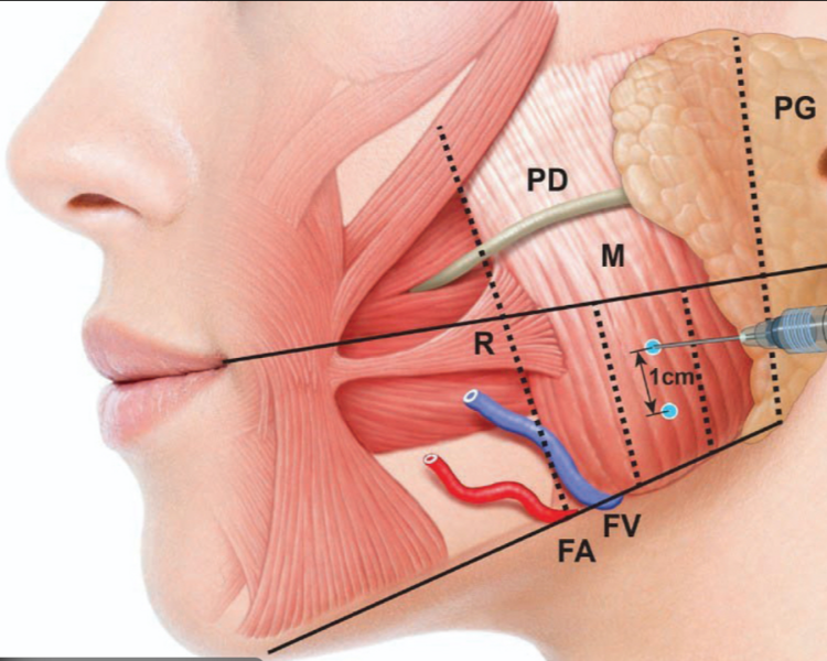 Tóxina Botulínica/ bruxismo