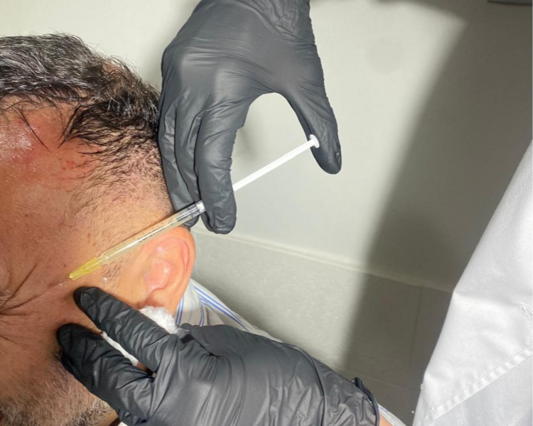 Mesoterapia Capilar