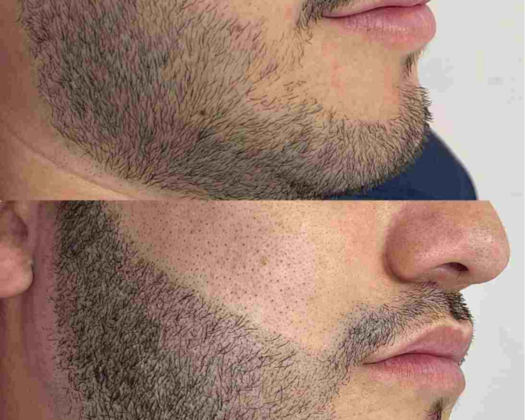 Micropigmentación Masculina Efecto Barba