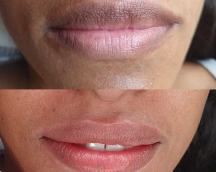 Neutralización labios 