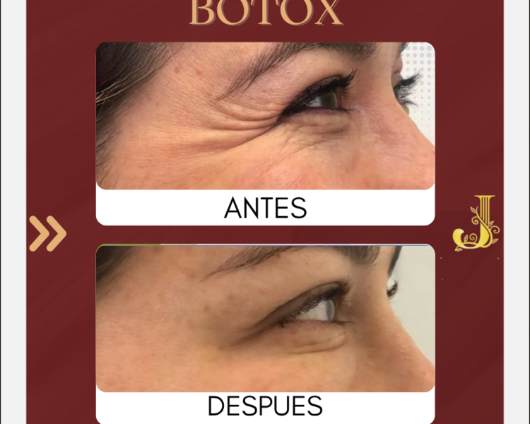 100 UNIDADES BOTOX