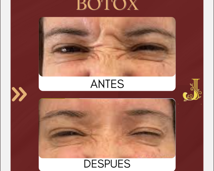 2x1  50 UNIDADES DE BOTOX ( tu y acompañante )