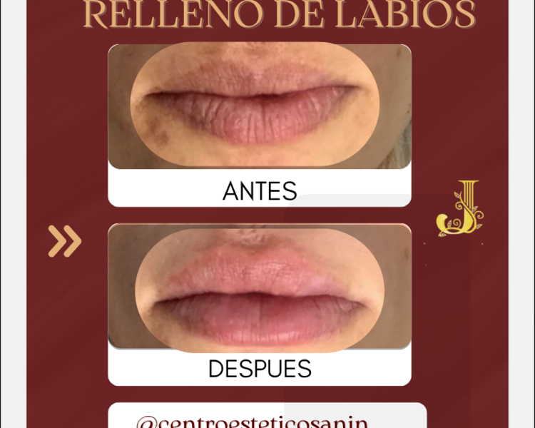 2x1 PERFILACION DE LABIOS 