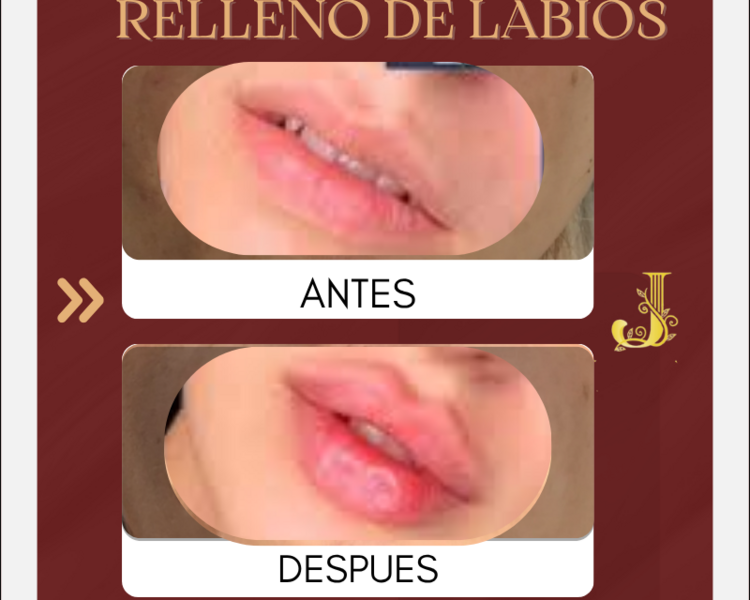 RELLENO Y PERFILACION DE LABIOS