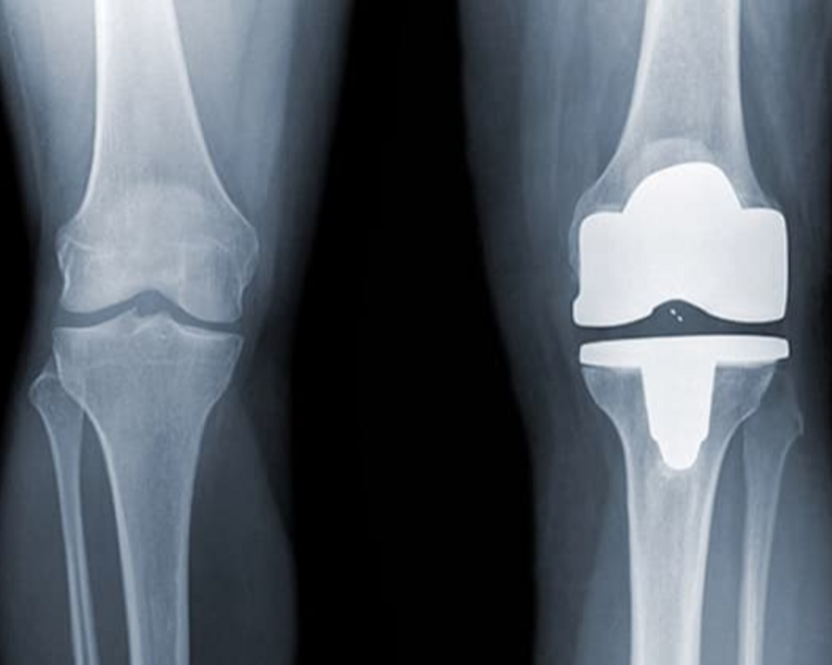 Drenaje Linfático Post Operatorio Traumatología