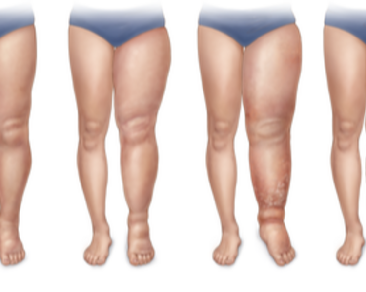 Linfedema Miembro Inferior