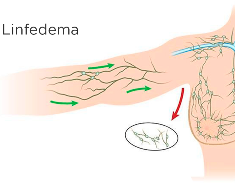 Linfedema Miembro Superior