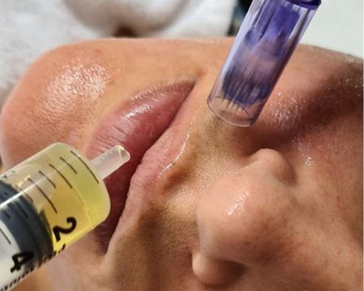 Plasma Rico en Plaquetas