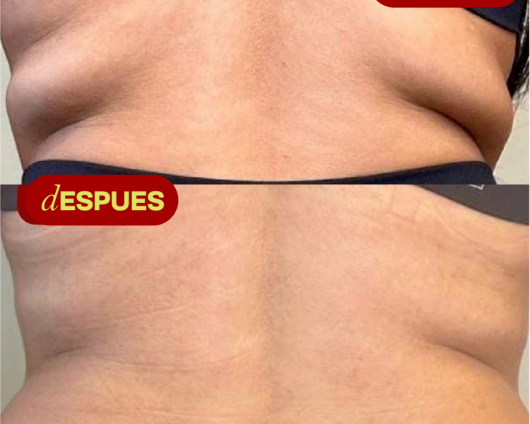 Inyeccion Lipoliticas