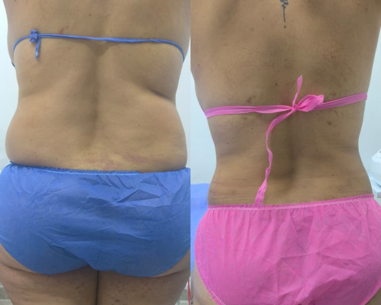 HIDROLIPOCLASIA CON MICROCANULA 