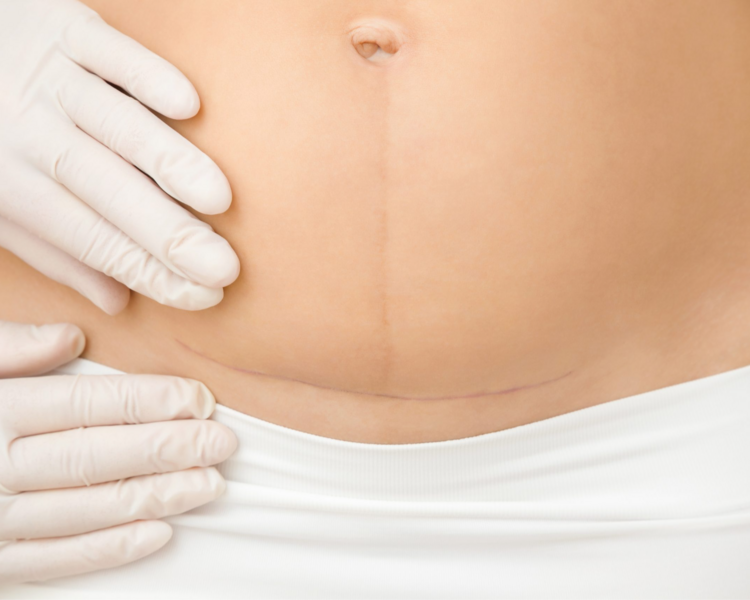 DRENAJE LINFATICO POST PARTO