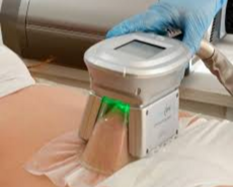 CRIOLIPOLISIS  (1 sesion de 2 zona)