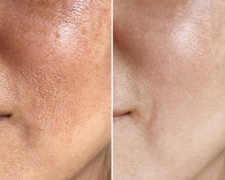 Limpieza facial de lujo