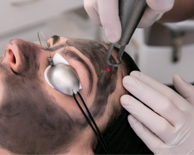 Hollywood Peel 1 Sesion