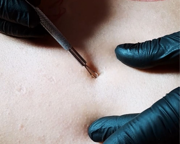 Limpieza Profunda de Espalda 