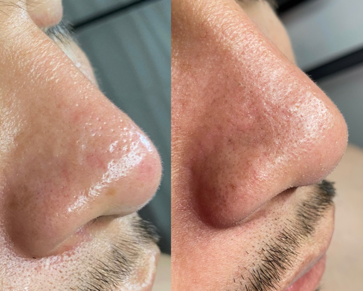 TRATAMIENTO FACIAL PERSONALIZADO 