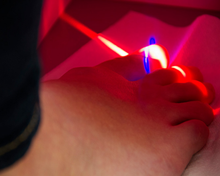 Tratamiento de Onicomicosis